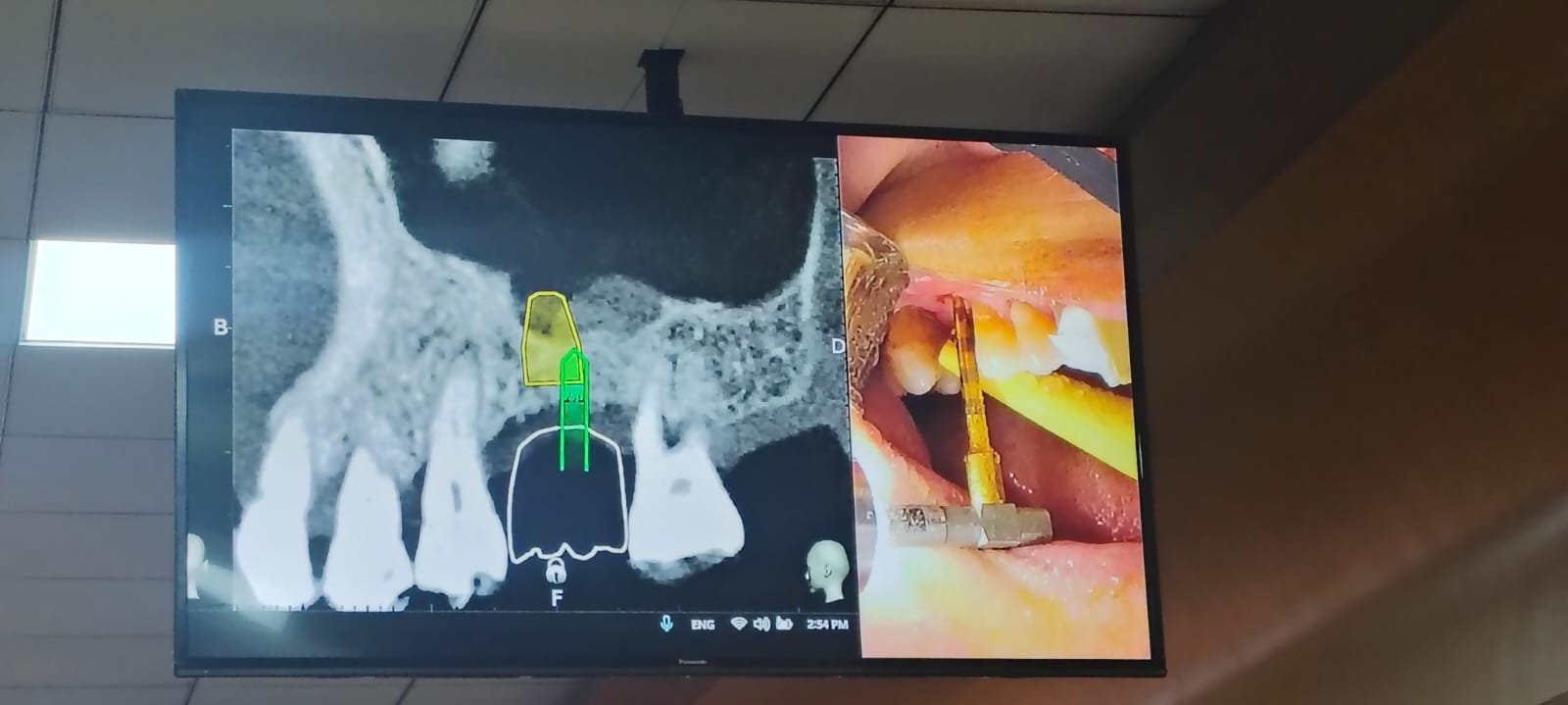 Live Surgical & Prosthetic Workshop - Digital Implant Placement